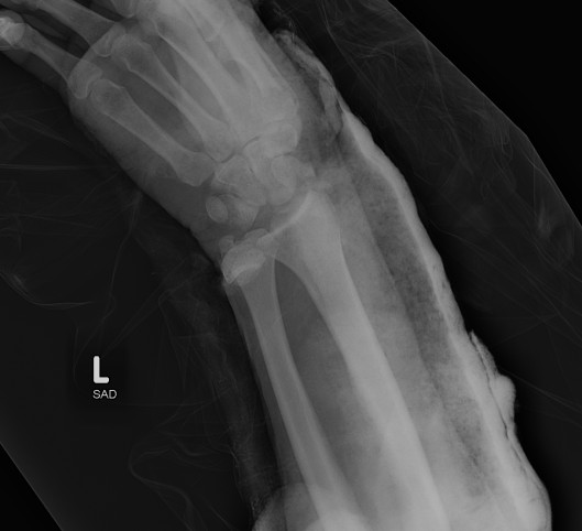 CIND Dislocated Radiocarpal Joint AP